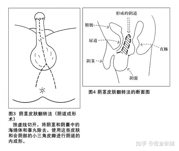 性别认同障碍的基础与临床 9 性别认同障碍的手术治疗 知乎