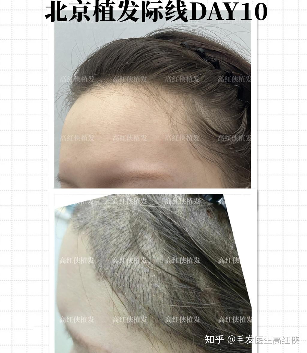植发专家指出：面部不对称从额头矫正开始 - 哔哩哔哩