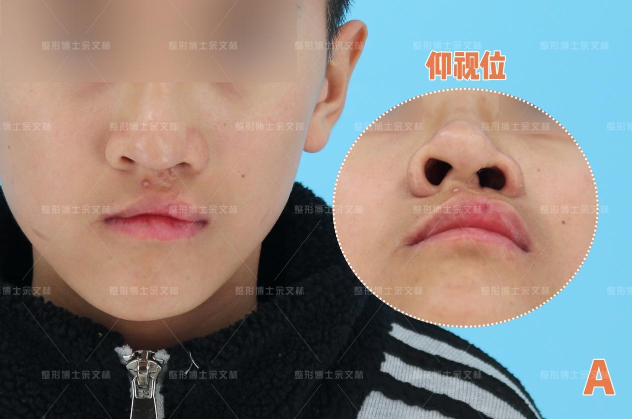 【案例分析】他唇鼻畸形明显,却只想改善疤痕问题,手术效果如何? - 知乎