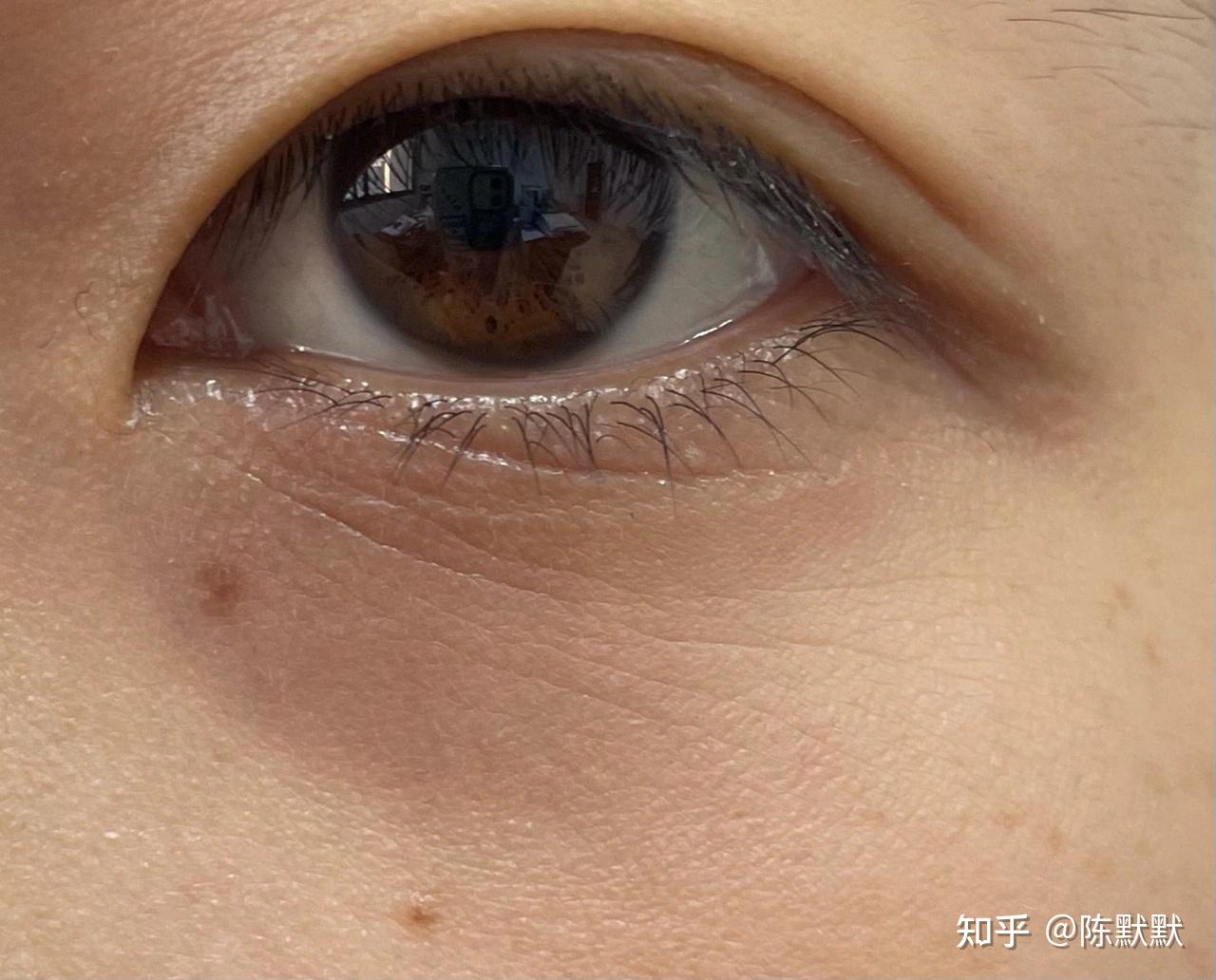 眼圈发黑是什么原因眼圈发黑怎么办用眼霜可以消除眼圈发黑吗