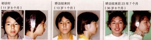 小时候很好看 你的颜值是怎么一步步垮掉的 知乎