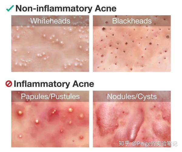 粉刺和痘痘的区别是什么 它们之间有什么不同 知乎