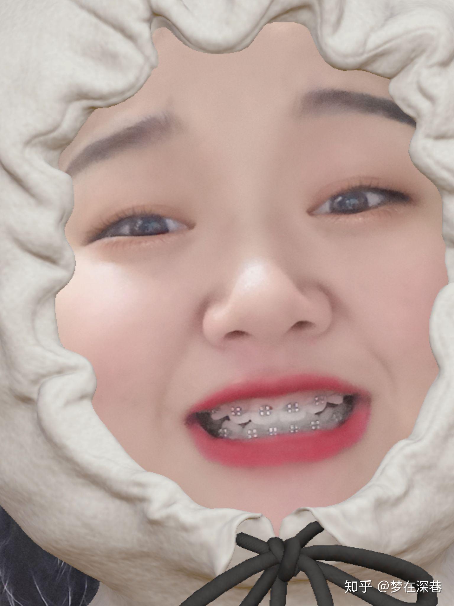 你们戴牙套都戴了多长时间？