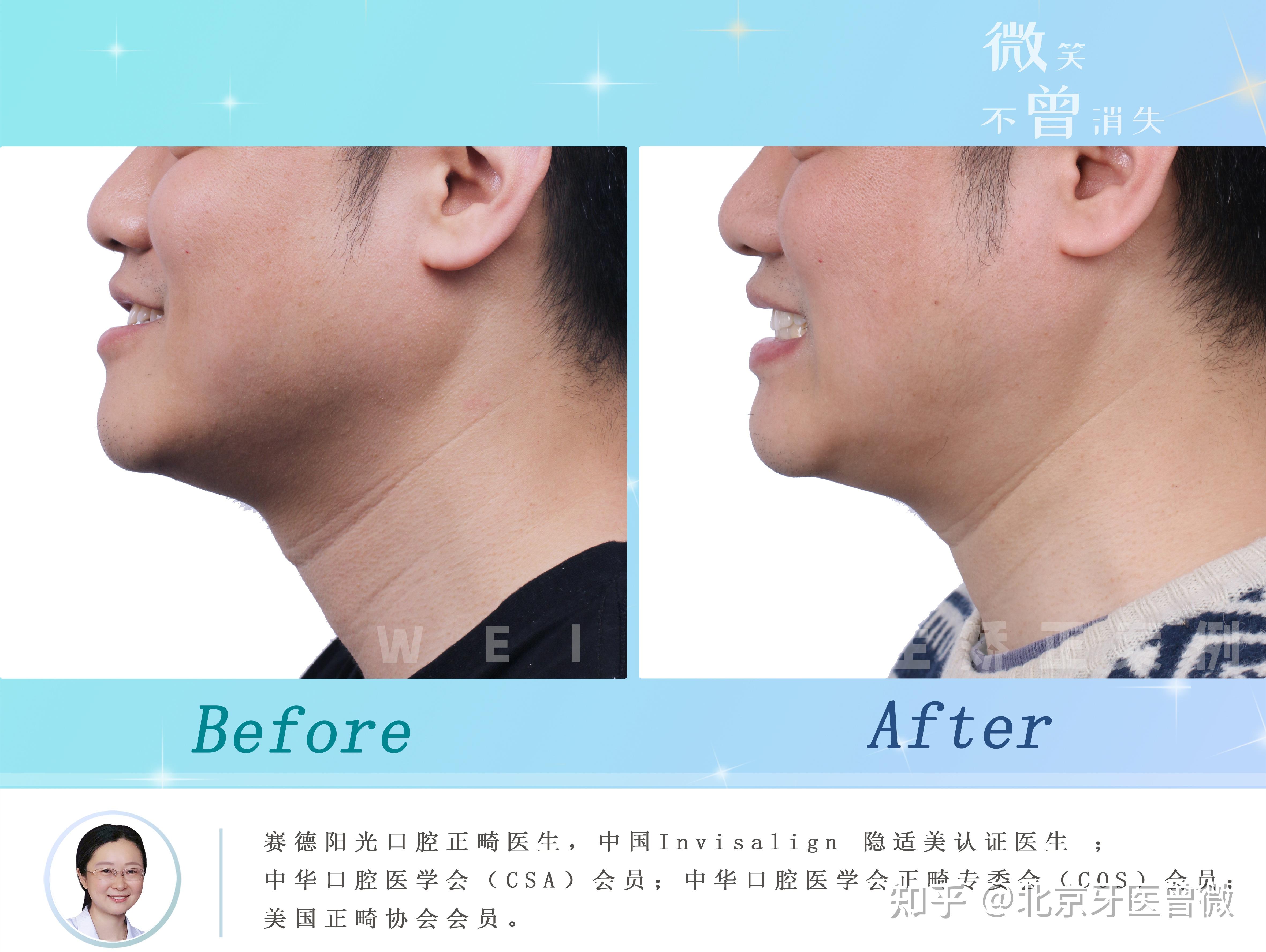 上颌发育不足导致的地包天面型 - 知乎