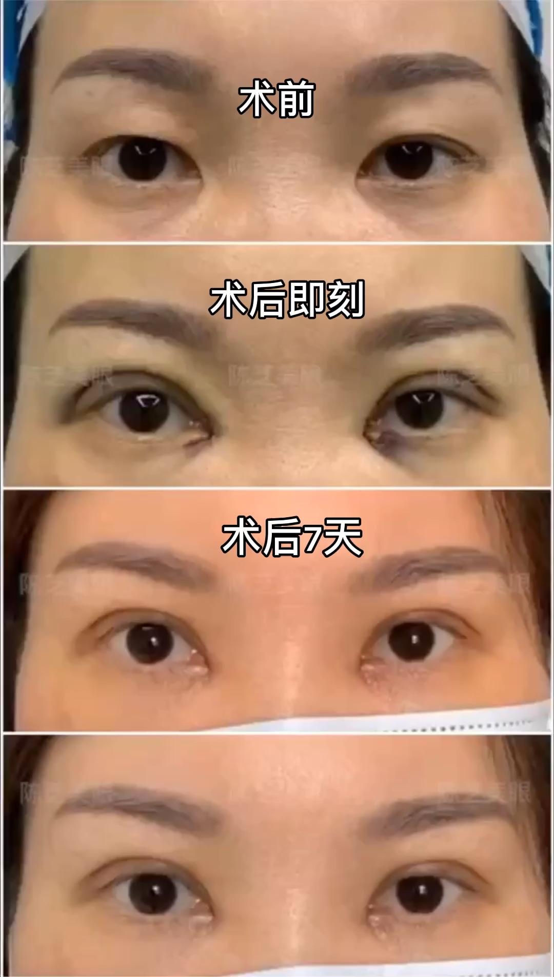 做了双眼皮提肌手术,术后恢复期出现不对称情况,是手术失败了吗