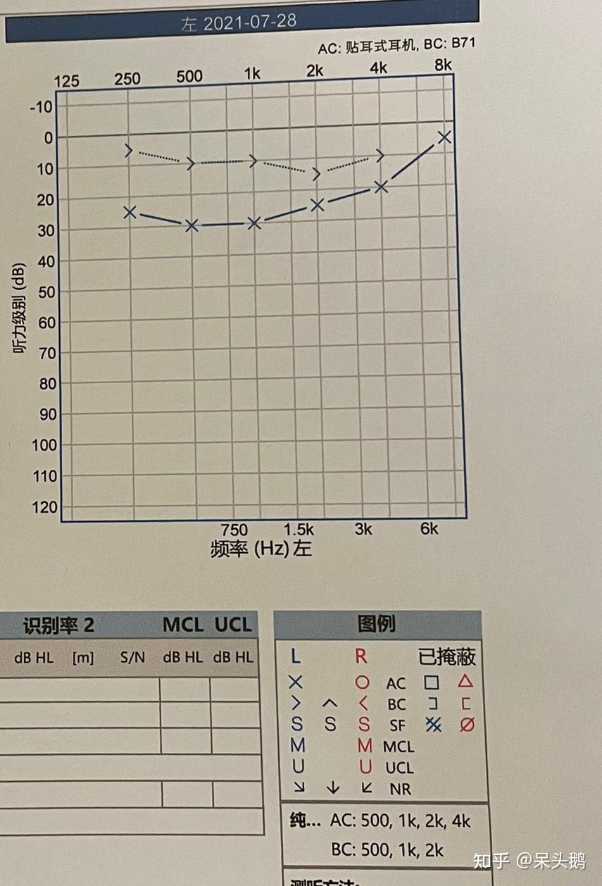 20多岁听力下降是什么体验耳硬化