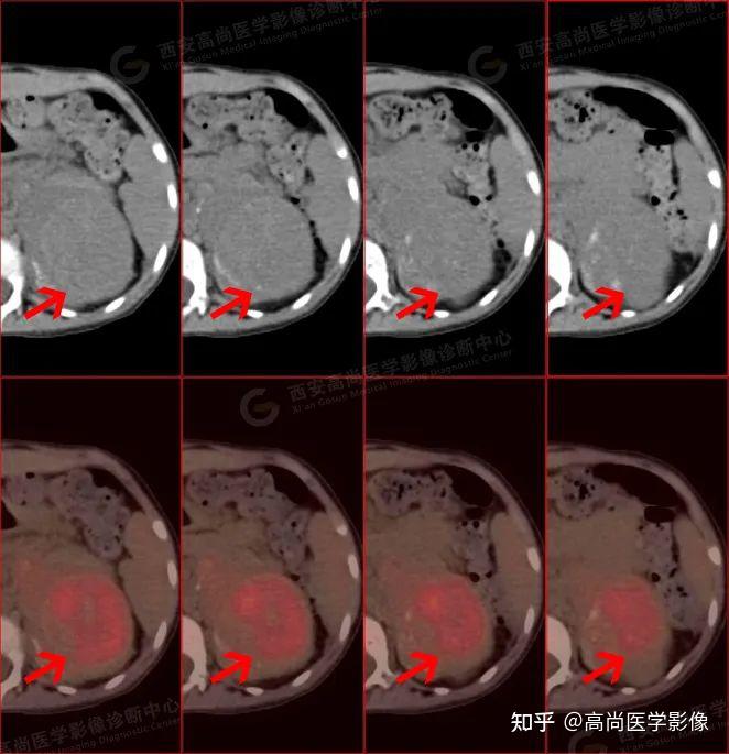 18F-FDG PETCT诊断肾上腺神经母细胞瘤一例【高尚医学影像】 - 知乎