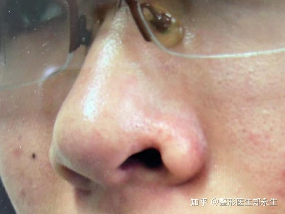 被狗咬造成鼻翼缺失还能修复吗