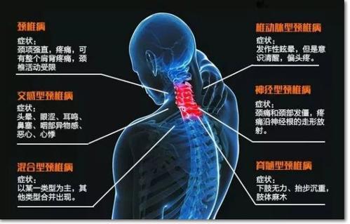 颈椎病56问 经典问答 快转发 知乎