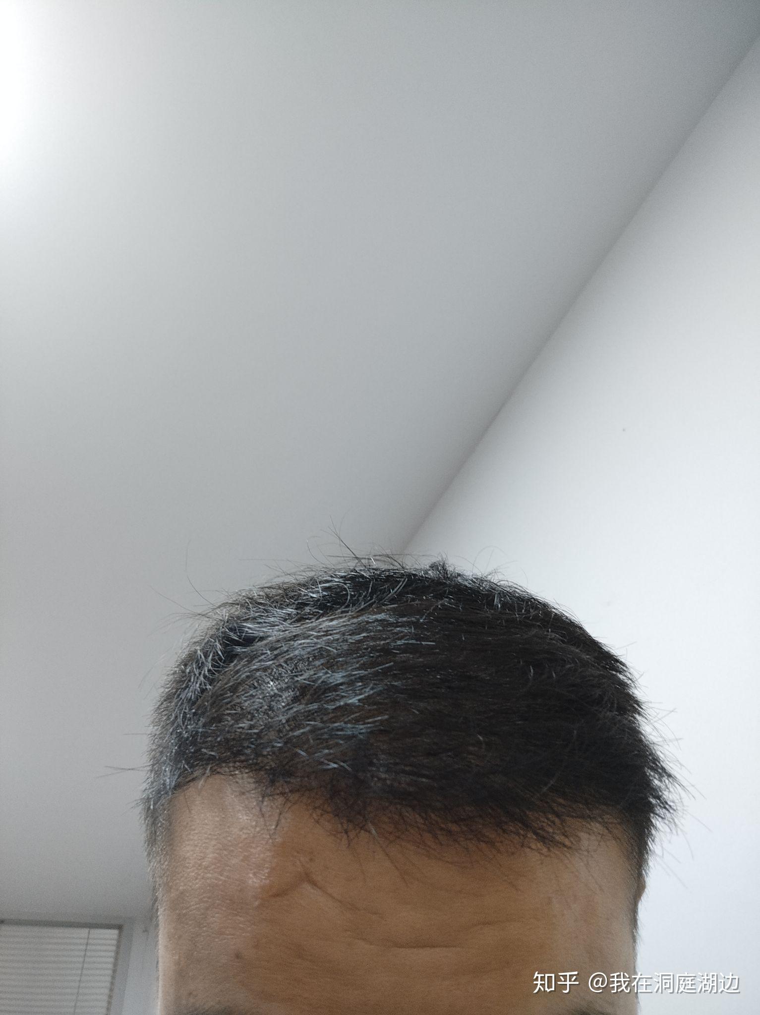 植发三周(植发三周后能喝酒吗)