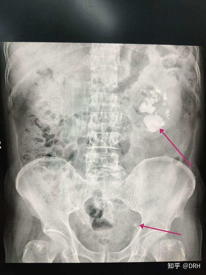 00cm,坐骨棘右侧可见多个点状致密影,余相当于双肾区,双输尿管径路及