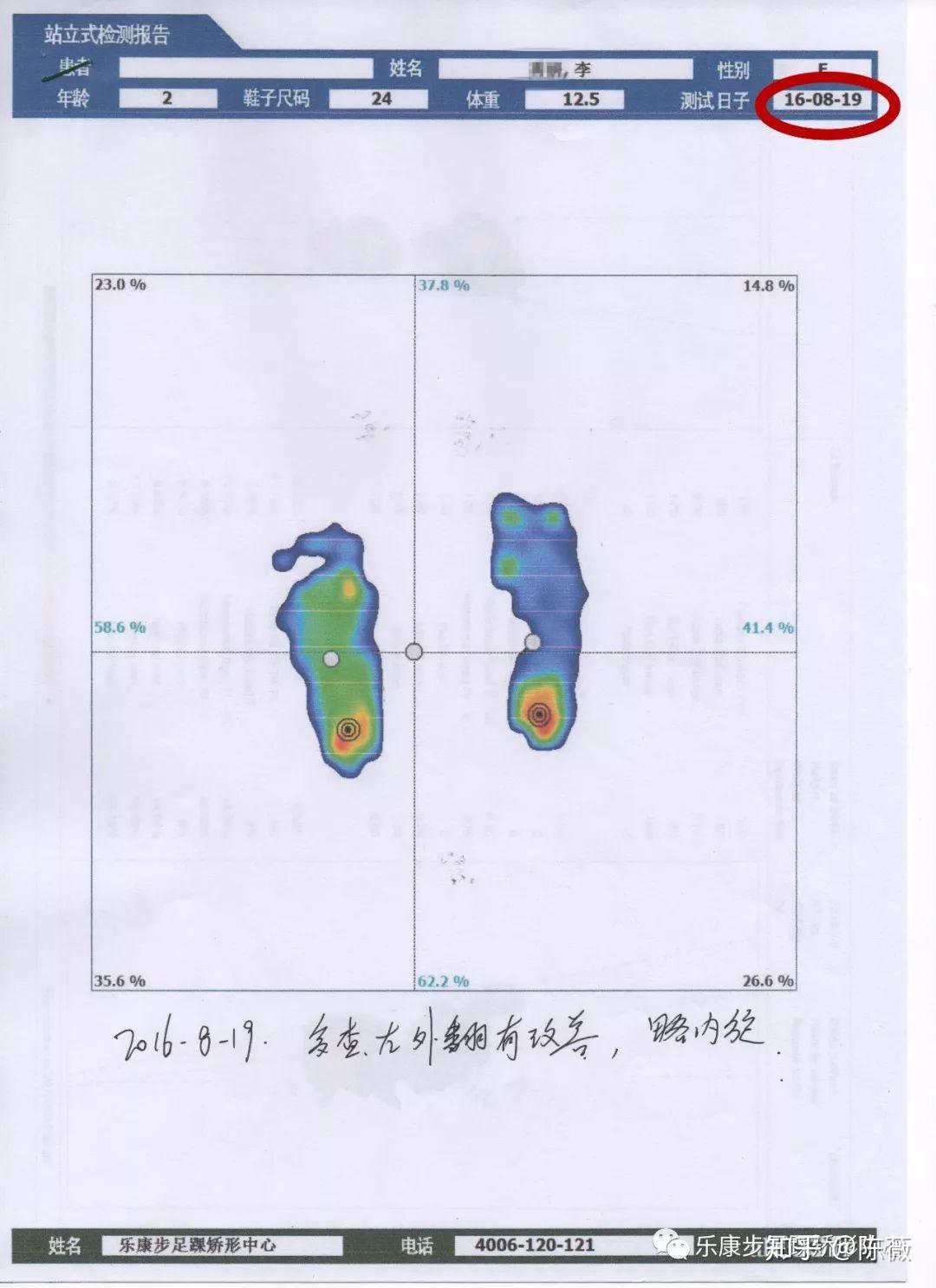 影響足外翻矯正效果的幾個因素低年齡足外翻兒童臨床矯正報告