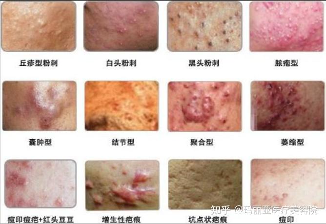 很多人就想问了为什么年轻的时候容易【长痘痘】? - 知乎