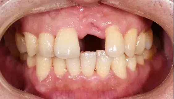 诊断:21牙牙列缺损· 术前cbct检查:缺牙区牙槽骨高度正常,宽度不足