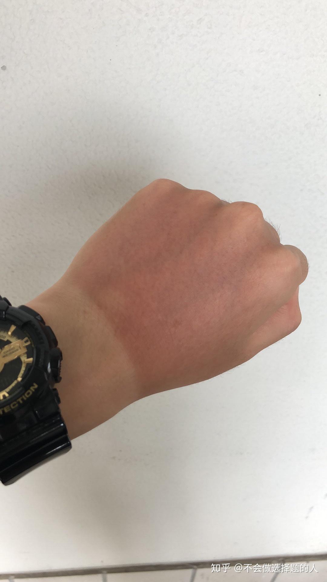 骑摩托俩小时手晒黑了还能白么