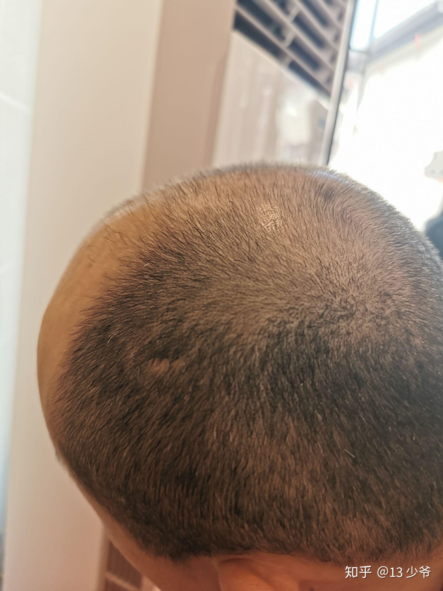 头部这样的疤痕如何修复