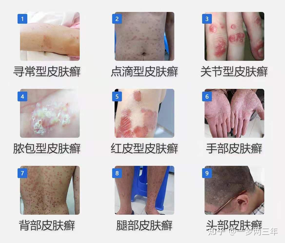 18种常见的皮肤病图片图片