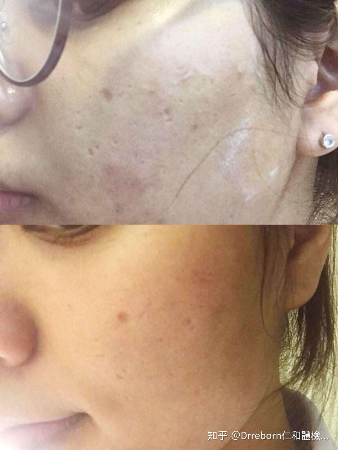 用什么可以祛痘坑 v2-14b8aaec5cc3f88dac9694cf2c44586f_r.jpg