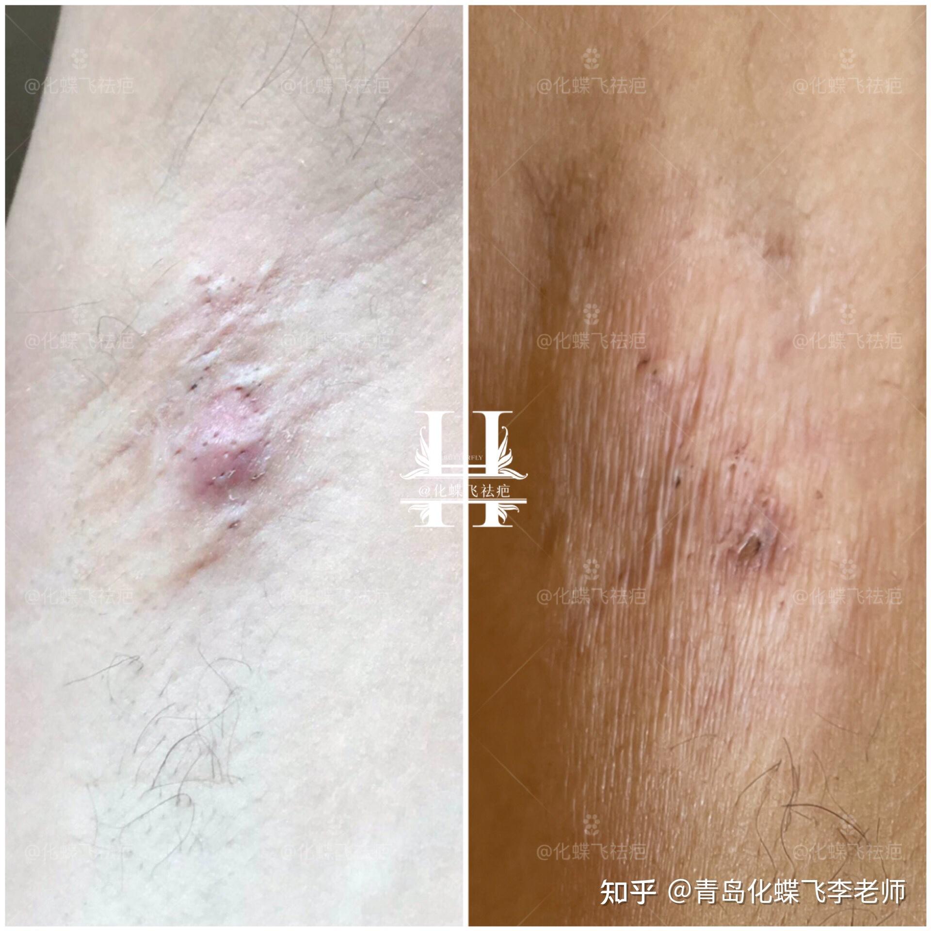 很多脏东西,效果非常显著 增生薄了 皱褶松开了 被覆盖的毛囊露出来了