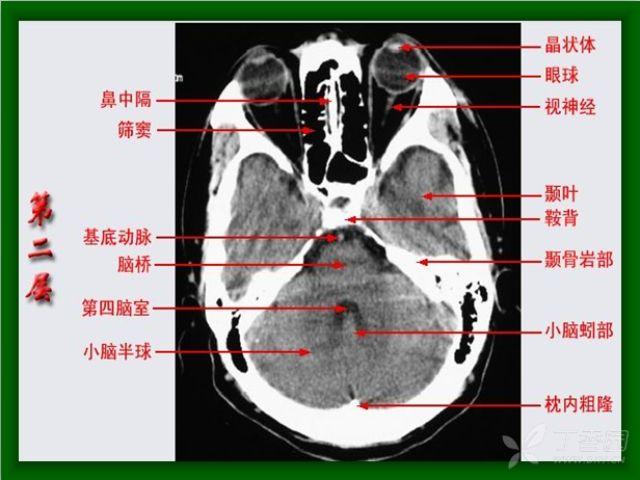 原创头颅ct解剖断层图解