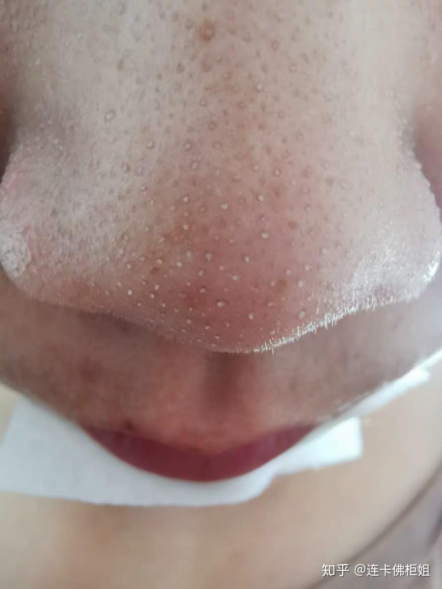 黑头的本质是什么?如何区别黑头? - 知乎