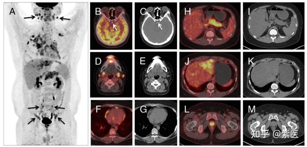 头对头比较!⁶⁸Ga-FAPI vs ¹⁸F-FDG PET/CT 在这种系统性纤维化病变中的差异全解析 - 知乎