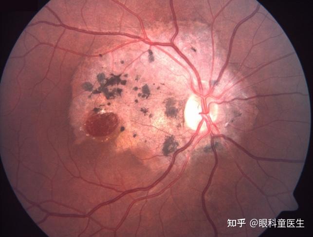 与外伤相关的视网膜病变——3,外伤性视网膜裂孔和脱离
