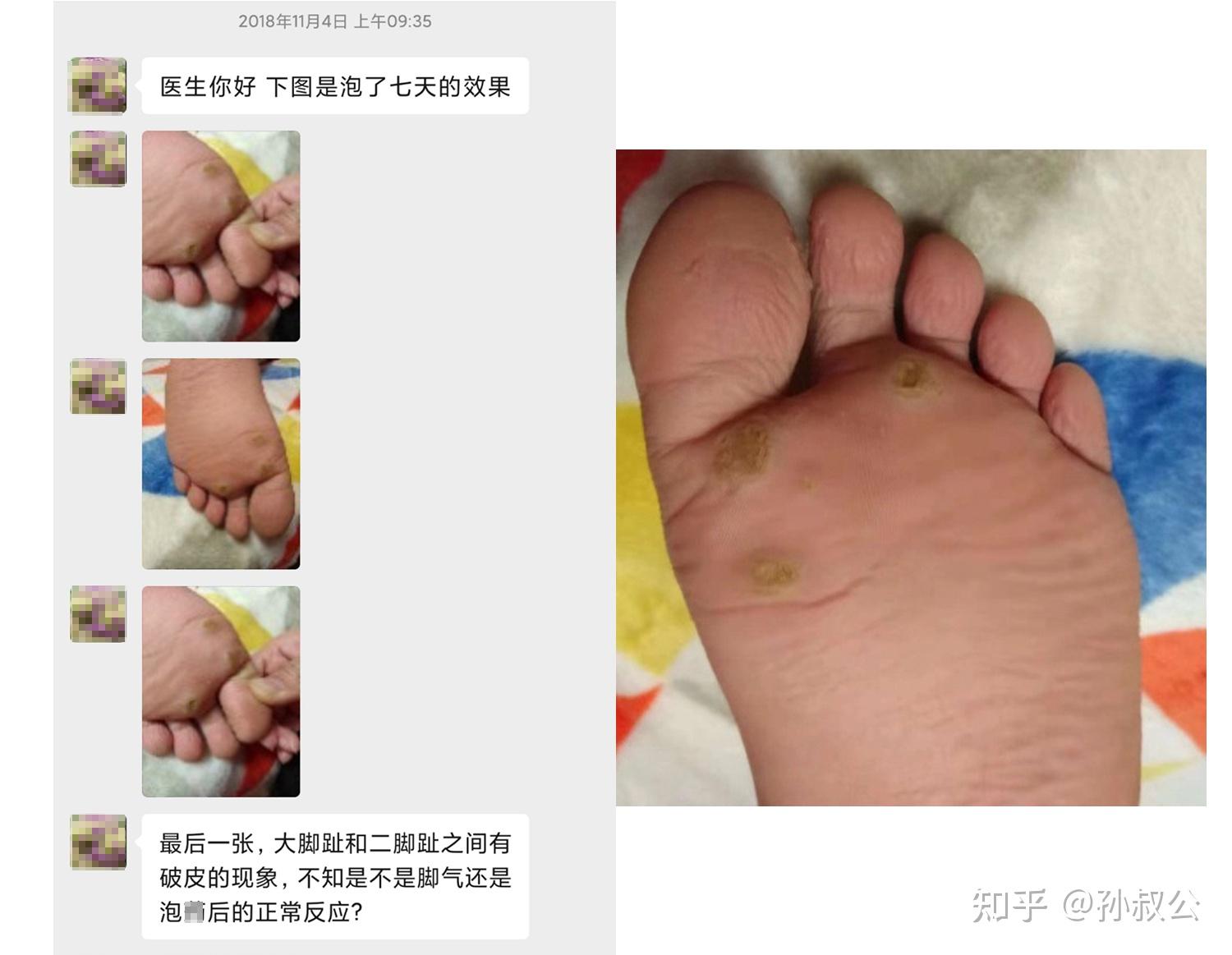 多颗跖疣20实例一招分清刺瘊鸡眼扁平疣详图版