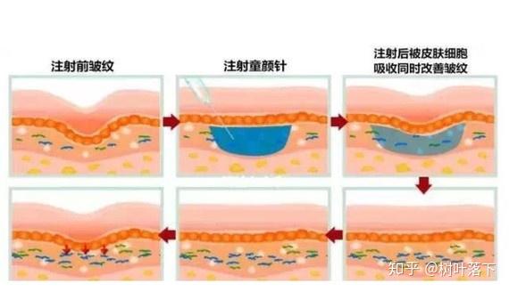 童顏針是生長因子嗎童顏針的危害大揭秘