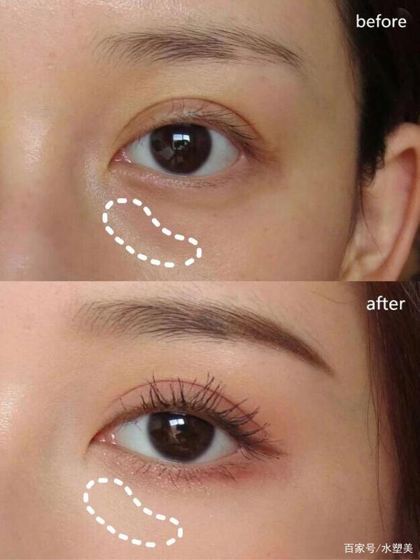 水剥离祛眼袋过程