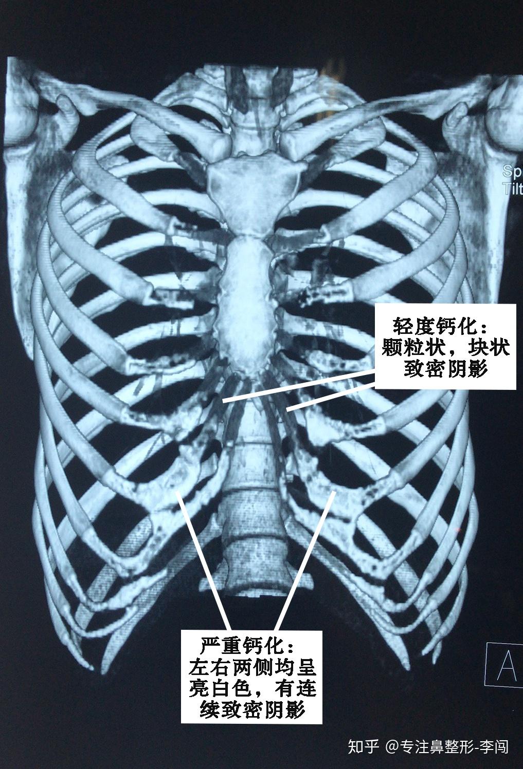 做的肋软骨隆鼻手术多了,也接触了各式各样形态的肋软骨.