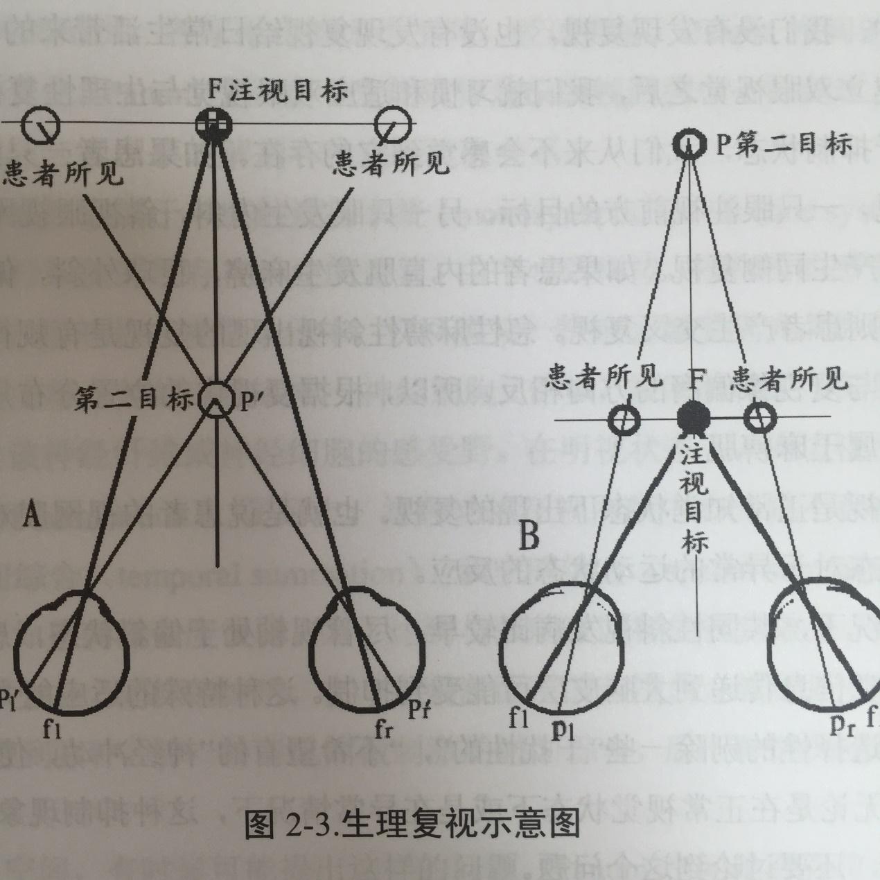 双眼视差大,看东西时会产生双像,这正常吗? - 知乎