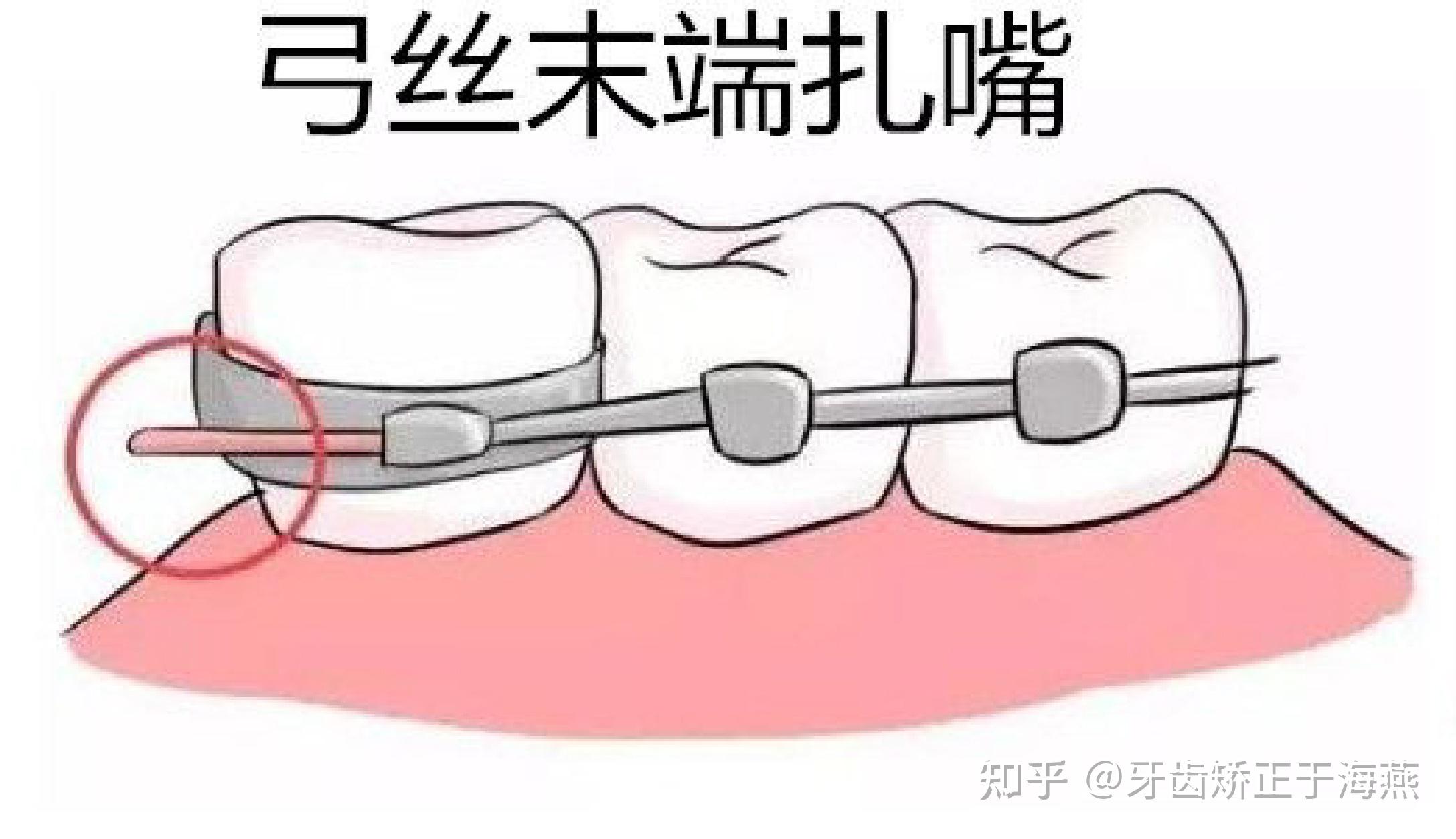 牙槽嵴顶的位置示意图-图库-五毛网