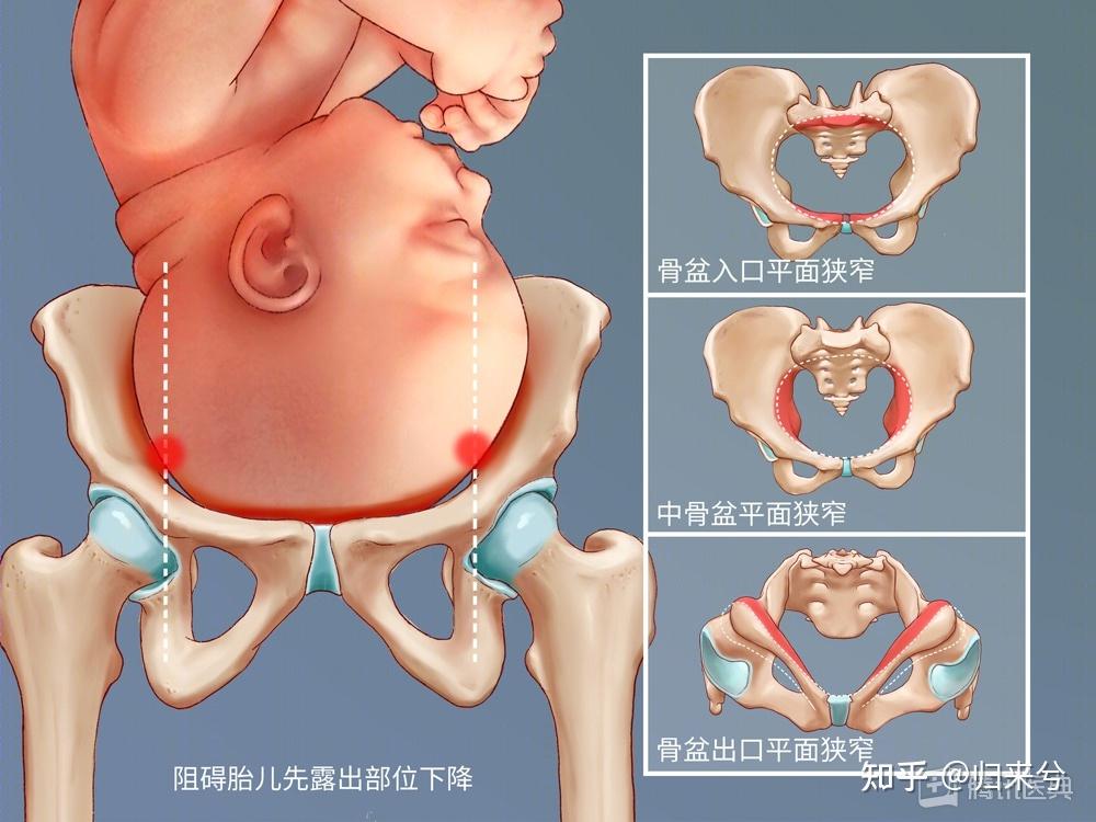 医生会检查测量骨盆入口,中间,出口各平面的大小,再和胎儿头部大小