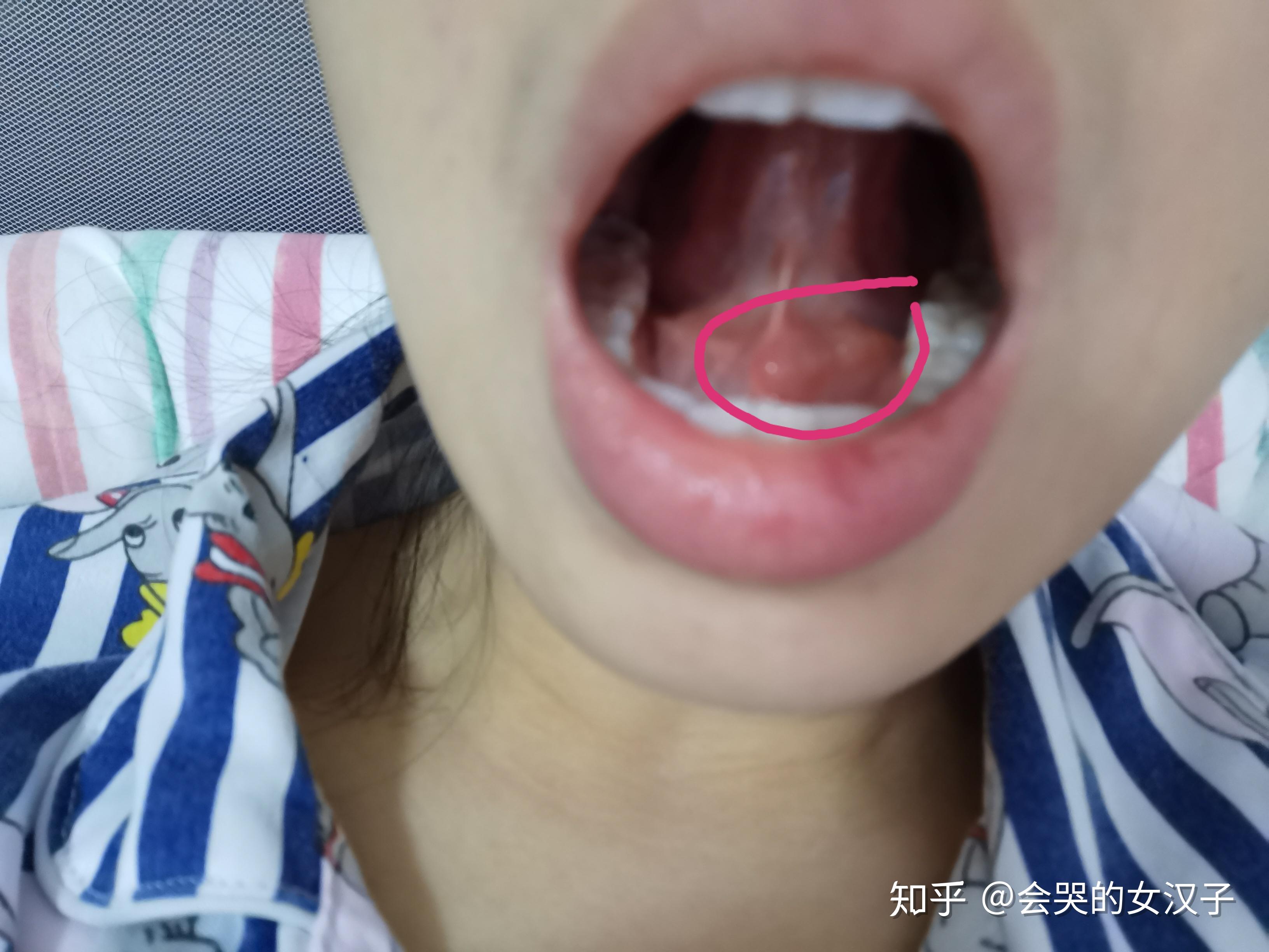 舌下脱敏治疗图片