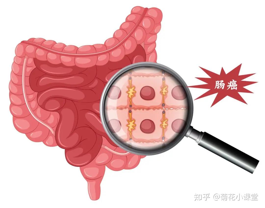 肠癌早期不痛不痒,大便出现4种异常要警惕,可能是早期信号!