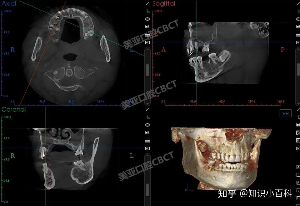 74種植術區重要解剖結構與病變的判斷美亞口腔cbct