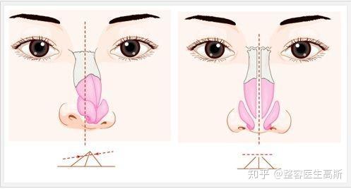 鼻子歪如何矫正 3步让鼻子 改斜归正 知乎