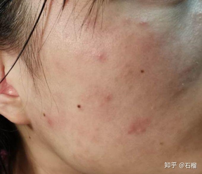 博乐达刷酸过度皮肤屏障受损过敏可愈益肤救我狗命010101