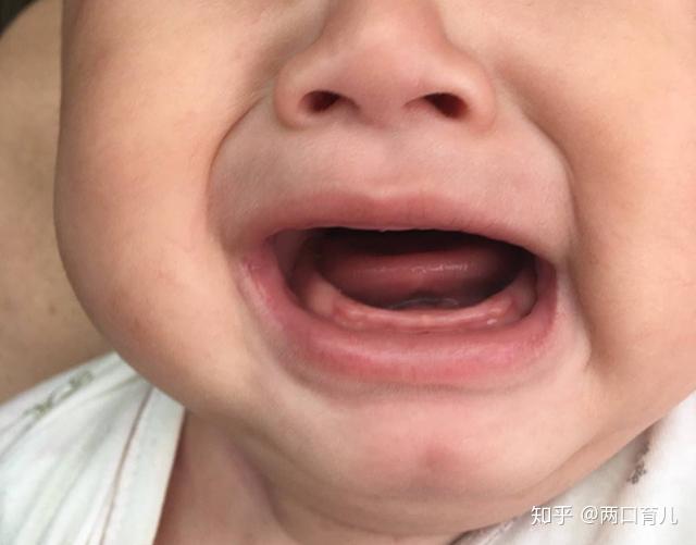 宝宝出牙前有症状对照出牙时间和顺序看看你家娃有没有达标