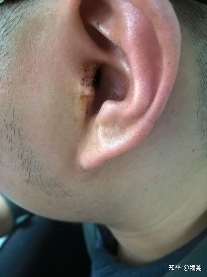 慢性中耳炎导致穿孔,鼓膜穿孔修补手术住院治疗经验分享3