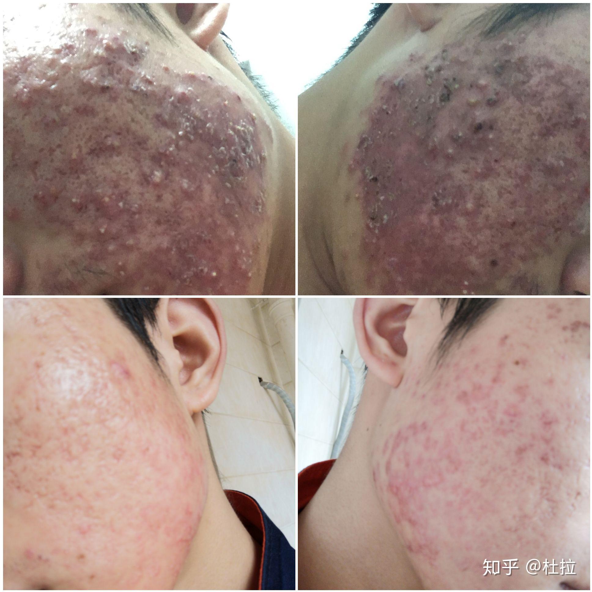 佳俊刷酸后对皮肤的伤害刷酸后皮肤屏障受损怎么修复呢