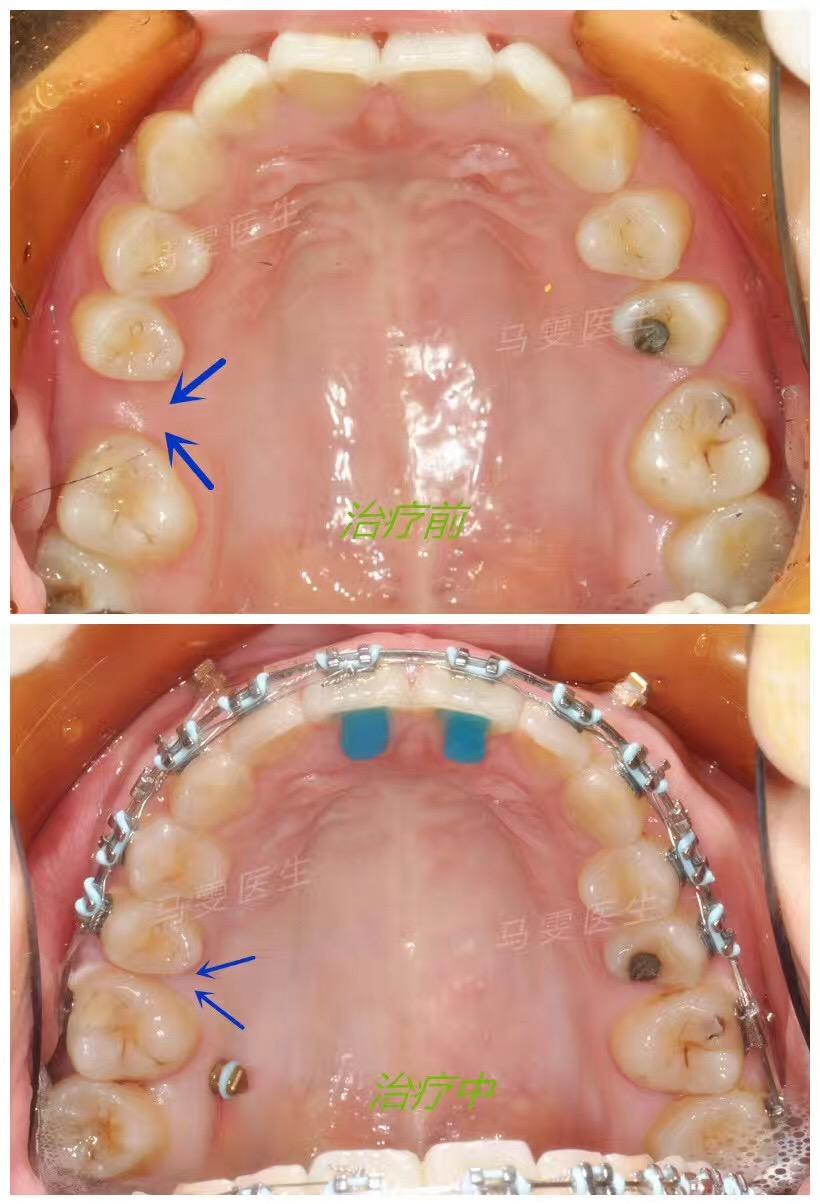 有下磨牙缺失一颗后用智齿前移的病例吗