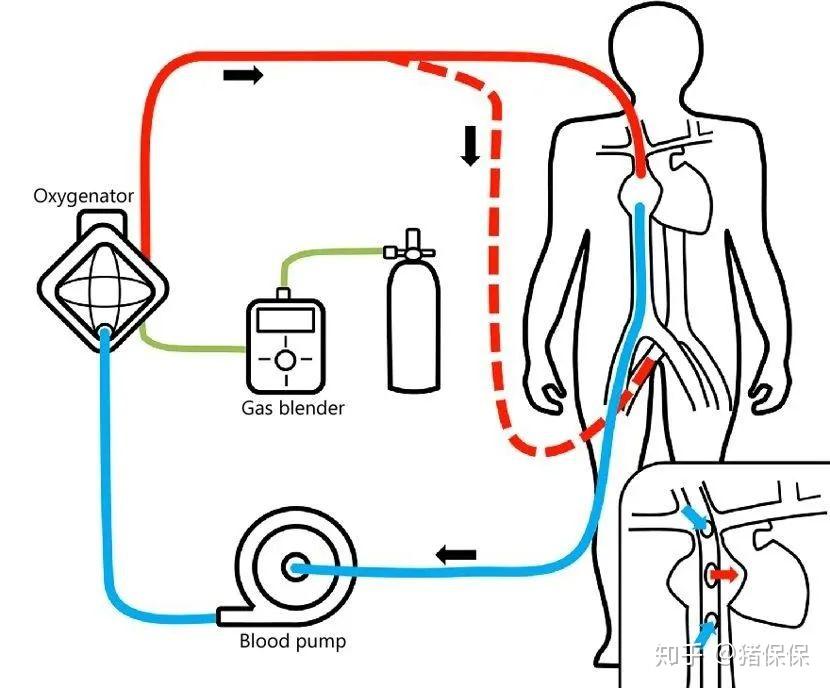 ecmo管路示意图图片