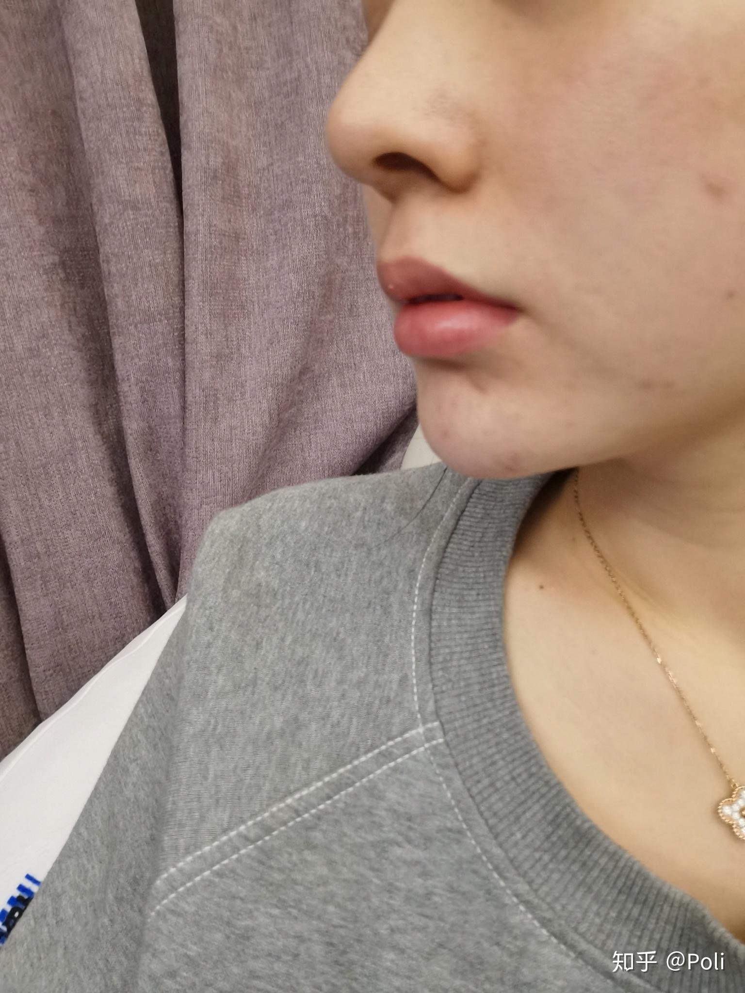 第二次鼻修复第三个月鼻头还是往下掉