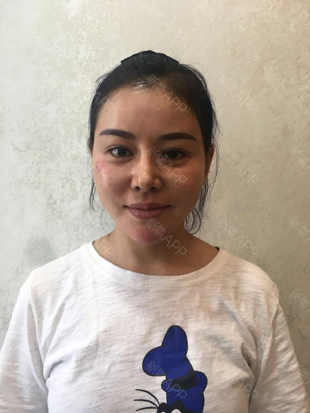 整容案例酒窝成形术人造酒窝原来有了酒窝可以笑得这么没