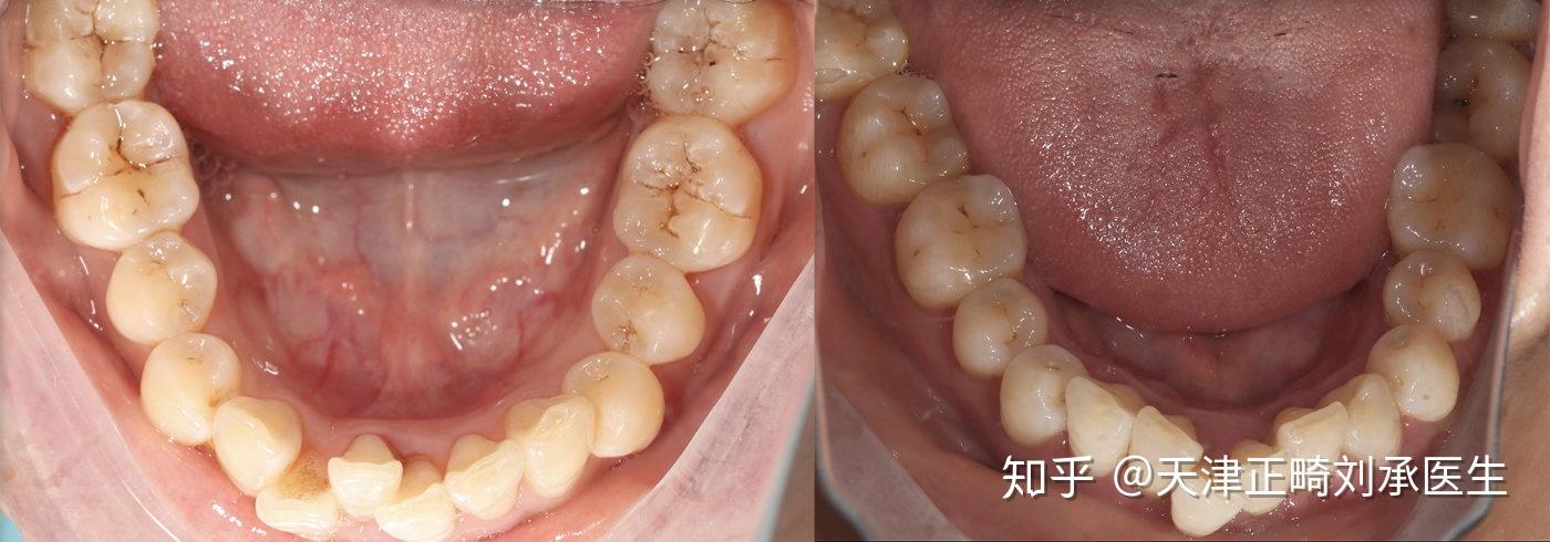 天津正畸医生刘承 |下前牙过度拥挤而形成的深覆合的案例分析 - 知乎