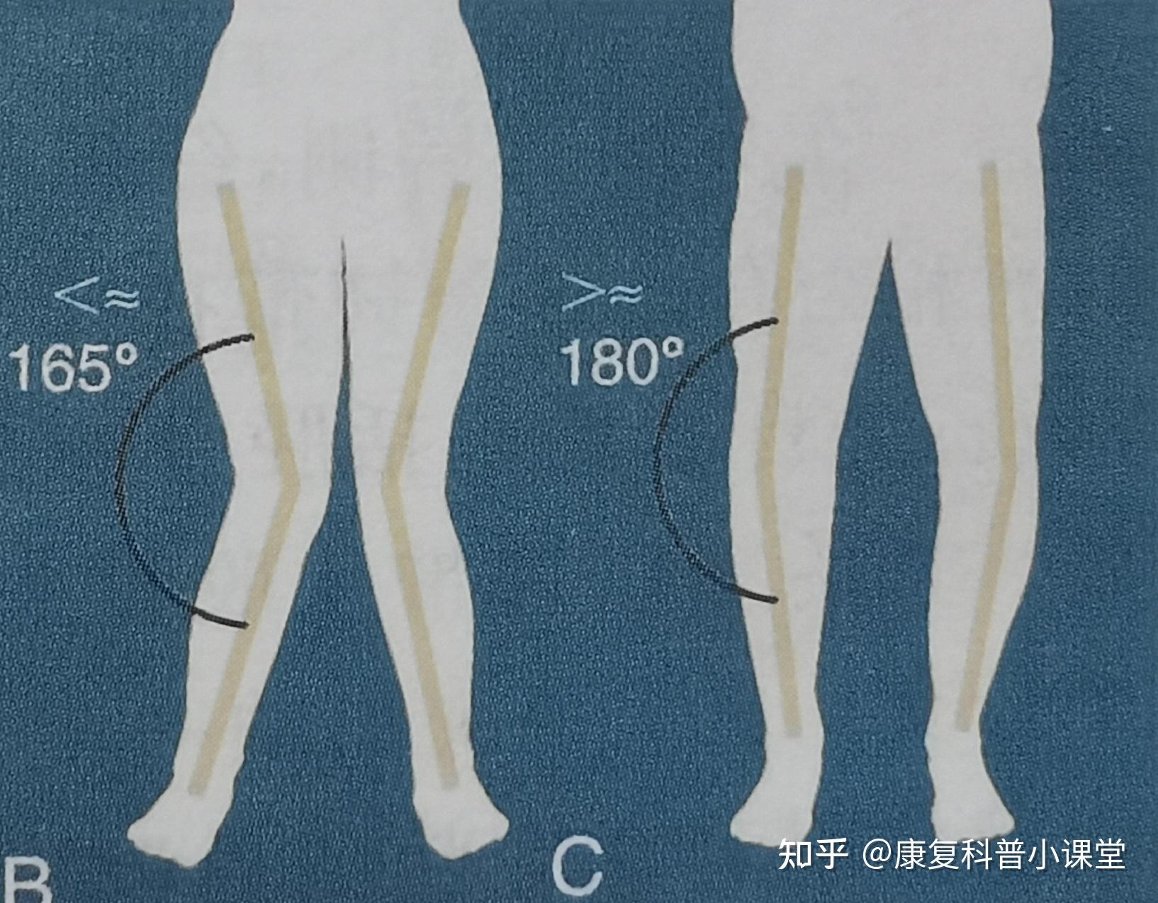 x 型腿能好吗 v2-1638a850a979c6b671d91f75d023c587_r.jpg