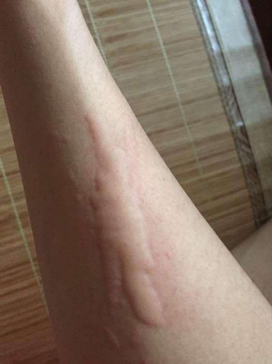 避免再起浑身的疙瘩秋季预防荨麻疹复发常识