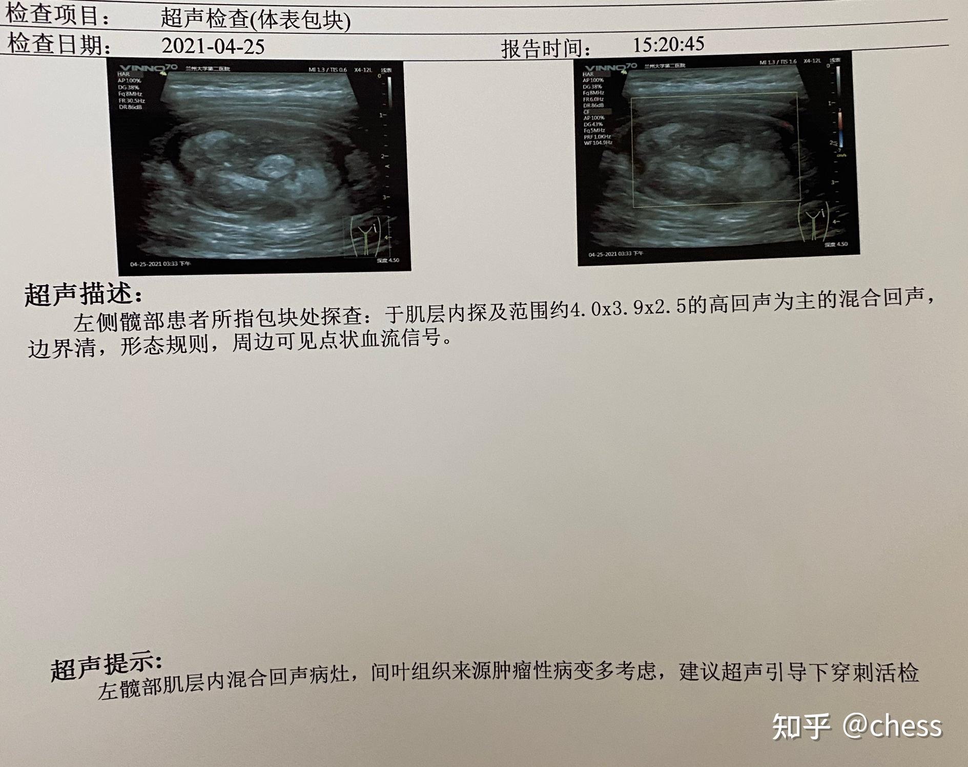 高分化脂肪肉瘤